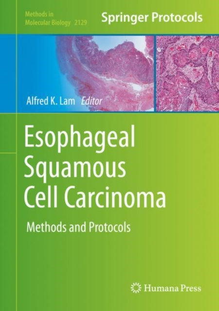 Esophageal Squamous Cell Carcinoma
